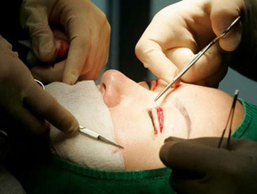 Phát hiện bác sĩ đang bị đình chỉ vẫn thẩm mỹ "chui"