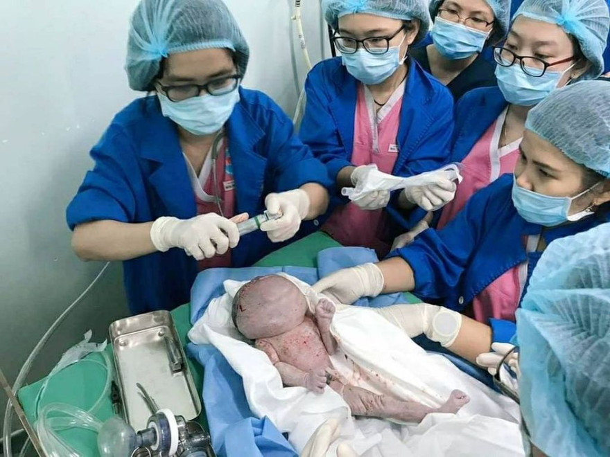 Trẻ sơ sinh vừa sinh ra đã mang khối u khủng trên mặt (ảnh: BVCC)