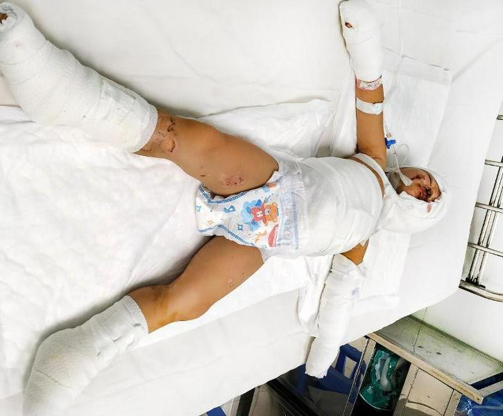 Trẻ nhập viện do phỏng xăng (ảnh: BVCC)