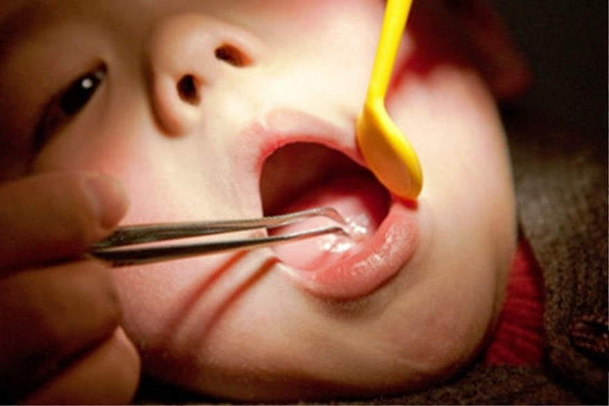 Nhiều trẻ nuốt dị vật do sự bất cẩn của người lớn