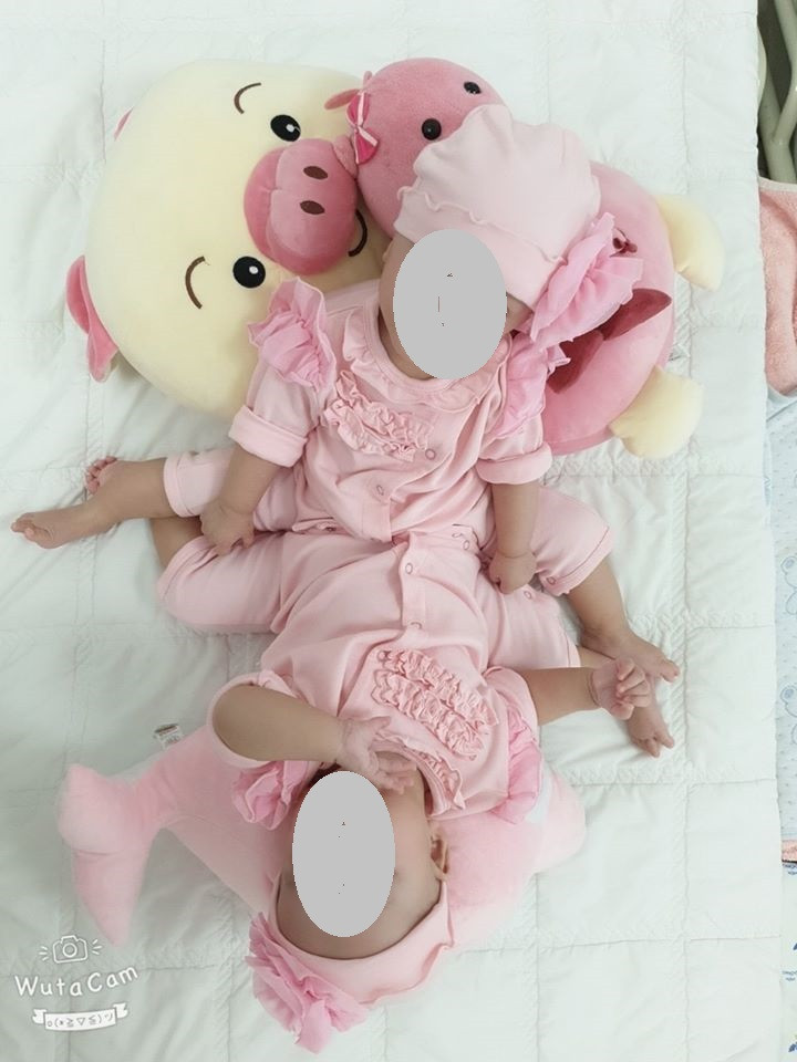 Cặp song sinh dính liền chuẩn bị được phẫu thuật (ảnh: BVCC)