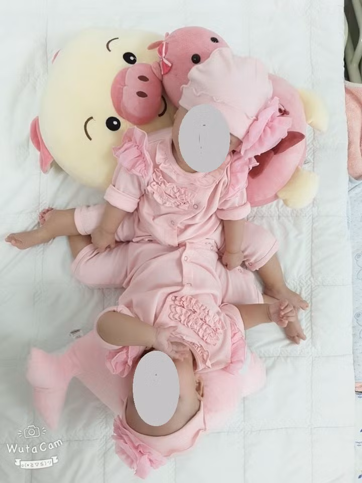 Cặp song sinh dính liền chuẩn bị được phẫu thuật (ảnh: BVCC)
