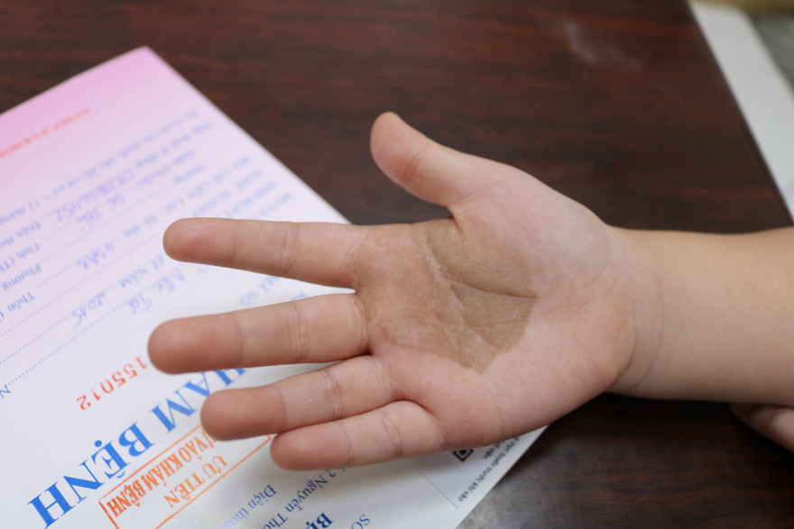 Nếu trẻ có các thương tổn sắc tố trên da, phụ huynh nên đưa trẻ đi khám