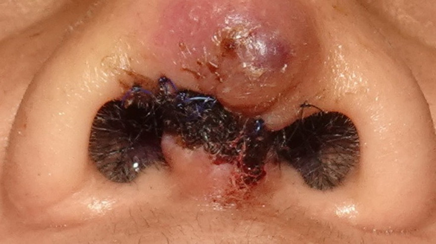 Trụ mũi đứt lìa khi nâng mũi ở bác sĩ "dạo"