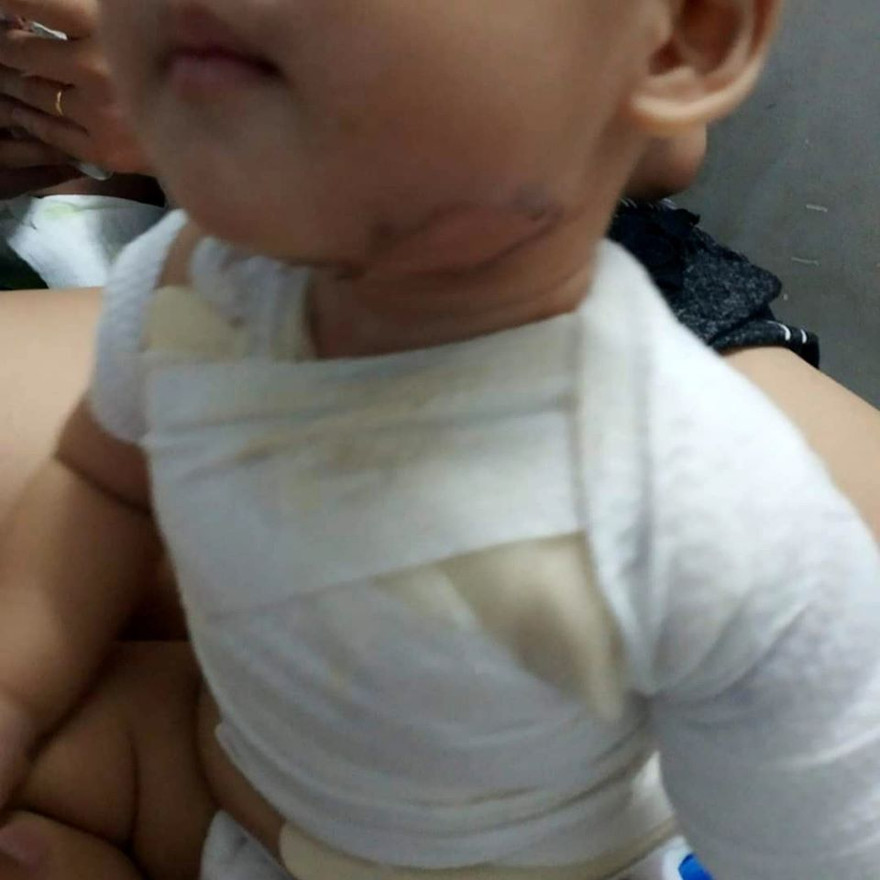 Bé trai bị phỏng nước sôi do gia đình bất cẩn