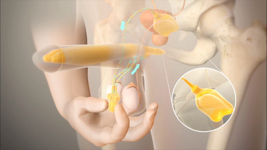 Thiết bị thể hang nhân tạo được xem là cứu cánh cho những bệnh nhân bị rối loạn cương dương khi những giải pháp điều trị thất bại