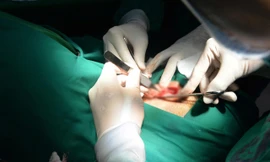 Bác sĩ gắp 5 con giòi sống ra từ ống tai bệnh nhân