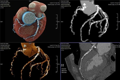 Bệnh nhân thoát nguy cơ ‘thượng mã phong’ nhờ chia sẻ chuyện phòng the