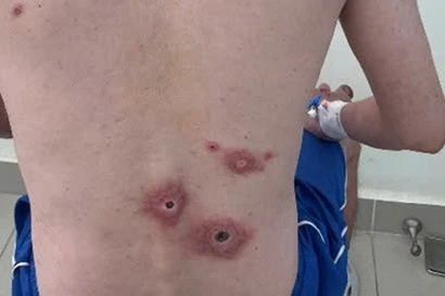 Nam nhân viên văn phòng lở loét toàn thân vì quan hệ tình dục bừa bãi