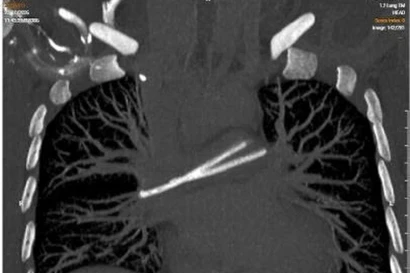 Ống truyền hóa chất trôi vào tim, bị 'bỏ quên' nhiều năm trong cơ thể