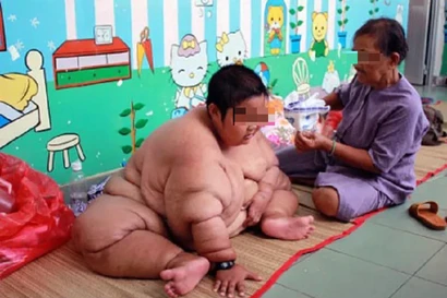 Đại dịch béo phì bùng phát, ca bệnh tăng chóng mặt tại Việt Nam