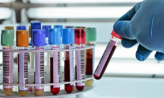 Lật ngược chẩn đoán viêm tụy nhờ phát hiện enzyme khổng lồ: Bất ngờ từ 1 ca bệnh hiếm gặp 