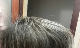 Điều trị thành công cho bệnh nhân 7 tuổi rụng toàn bộ tóc