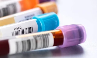 Cảnh báo gia tăng ca viêm não hiếm gặp do Parvovirus B19 ở Việt Nam