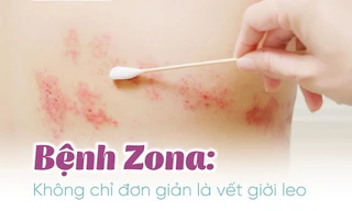 Zona thần kinh: Căn bệnh dễ gặp, biến chứng khó lường