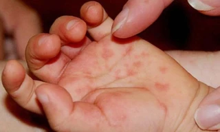 Nhiều ca bệnh tay chân miệng tăng nặng: Bộ Y tế chỉ đạo khẩn