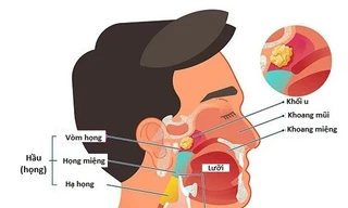 Người đàn ông mắc đồng thời hai ung thư nguy hiểm