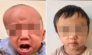 Mỗi ngày kéo giãn hộp sọ 1mm, bác sĩ thay đổi gương mặt trẻ mắc dị tật hiếm gặp 