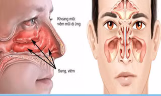 Đừng nhầm viêm mũi dị ứng với viêm xoang: Tự dùng thuốc có thể khiến bệnh nặng hơn
