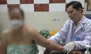 Zona thần kinh tiềm ẩn nhiều biến chứng nghiêm trọng