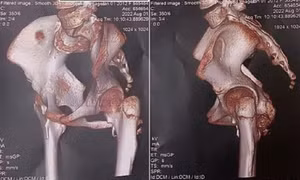 Phát hiện bé gái mắc hội chứng 'người hóa đá' cực hiếm