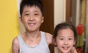 Cậu bé bỏng 97% cơ thể và giấc mơ thành nhà vô địch cầu lông