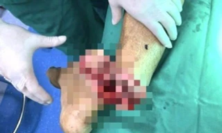 Bị chém gần đứt lìa chân khi mang hung khí đi tìm đối thủ