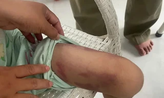 Bé gái 9 tuổi bị mẹ ruột cùng người tình đánh dã man trong phòng trọ ở TPHCM