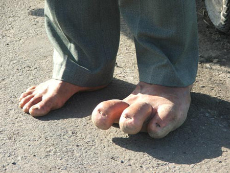 30 năm không đi dép vì bàn chân nặng gần 10kg