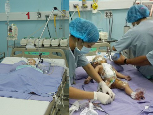 Những điều chưa biết trong ca mổ tách 2 bé dính liền
