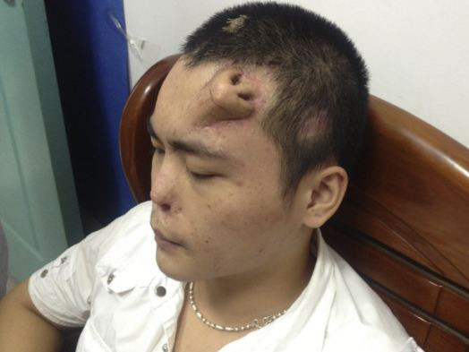 Mũi được tạo ra bằng sụn xương sườn trên trán