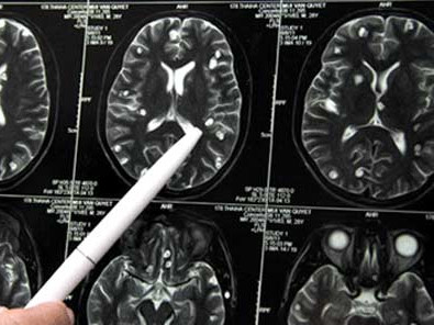 Sán lợn làm tổ trong não vì mê tiết canh, nem chạo