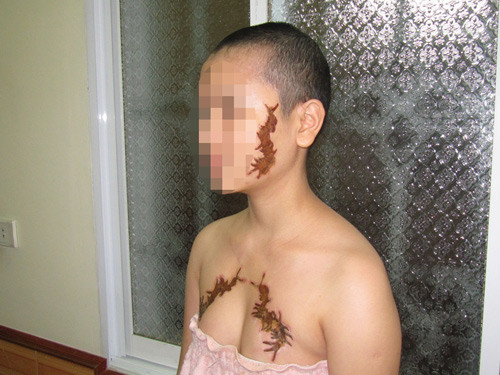 Các vết xăm đã được xóa nhưng vết thương vẫn còn hằn rất rõ trên cơ thể G. Ảnh: Khánh Hoan