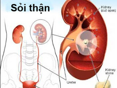 Bệnh sỏi thận rất dễ tái phát
