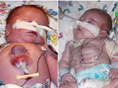 Cậu bé có trái tim ngoài cơ thể