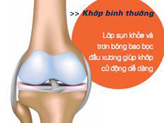 Cần biết về điều trị thoái hóa khớp