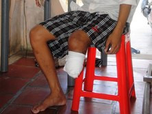 Bị cắt chân, bệnh nhân đòi bồi thường 204 triệu