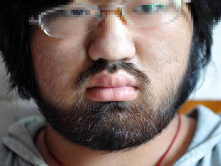 Cô gái 16 tuổi bỗng dưng mọc lông lá như người sói