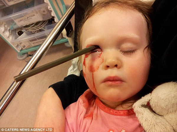 May mắn sống sót dù bị bút chì đâm vào đầu 4 cm