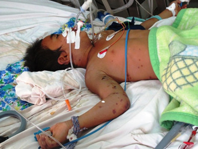 Ong đốt chết một người, bé 11 tuổi đang nguy kịch