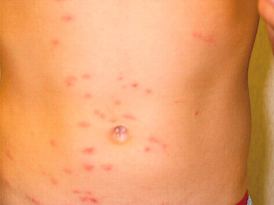 Ngứa do thời tiết rét nên đi khám chuyên khoa để được chỉ định dùng thuốc