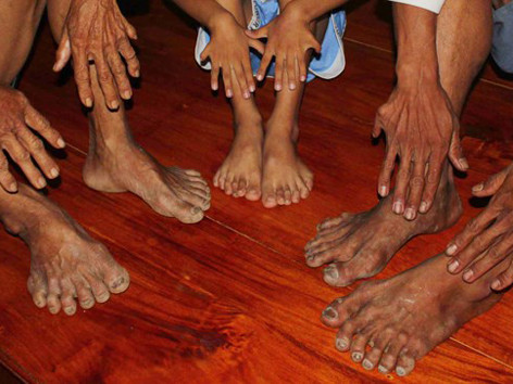 Gia tộc có 14 người chân tay 6 ngón