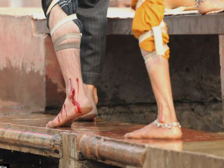 Chữa bệnh bằng trích máu ở Ấn Độ