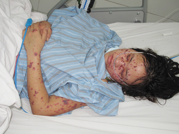 Bệnh nhân T. đang được điều trị tại Bệnh viện Bệnh Nhiệt đới T.Ư. Ảnh: BS Nguyễn Trung Cấp