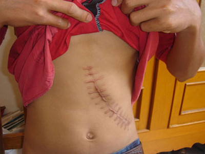 Người nghèo bán thận, được một, mất mười