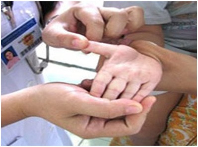 Phân biệt bệnh tay chân miệng với sốt virus nổi ban