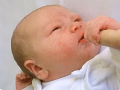 Bé bị chàm sữa do dính sữa mẹ?