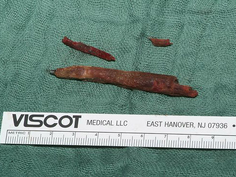 Chiếc bút chì được lấy ra khỏi đầu bệnh nhân