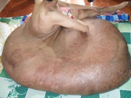 "Chân voi" khổng lồ khiến cuộc sống anh Hải khổ sở trong thời gian dài