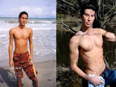 Chàng trai 128 lần phẫu thuật thẩm mỹ